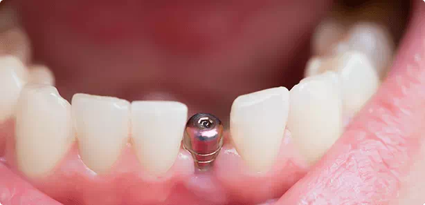 義歯・インプラント・歯の移植