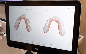 iTero エレメント 5D